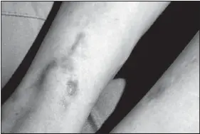 cigarette burns bdsm An Interview With the Man Who Pays Me to Burn His Feet With Cigarettes While He Do Cigarette Burns Scar? What