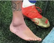 ?? — AFP ?? Painful encounter: Picture of the swollen ankle of brazil’s neymar after the Serbia game.