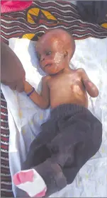  ?? Photo: Contribute­d ?? Agony… Baby Pombili survived a home fire in July 2020.