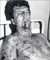  ??  ?? The badly injured Jonathan Jeffers. He still suffers post traumatic stress from the incident, 31 years on.