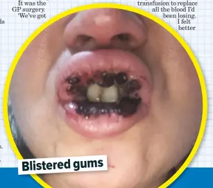  ??  ?? Blistered gums