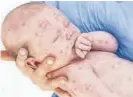  ?? ?? Un bebé con marcas de sarampión.