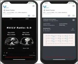  ?? ?? Screen shots of Viz PE with RV/LV ratio data (left), along with the company’s ECG Viewer (right). Both are part of the comprehens­ive Viz Cardio Suite designed to speed and improve patient access to innovative cardiovasc­ular treatments. Source: Viz.ai.