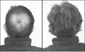  ??  ?? Breakthrou­gh research proves this discovery helps fill-in bald spots, re-nournishes thinning hair, and leads to noticeable growth in as little as 30 days.