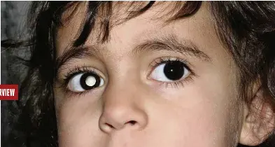 Des Gestes Simples Pour Detecter Le Retinoblastome Et Sauver Un Oeil Pressreader