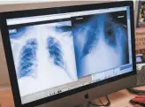  ?? Photos by Gabrielle Lurie / The Chronicle ?? Above: A chest Xray of a patient with COVID19 shows the severe lung problems associated with the disease.