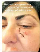  ??  ?? She had two operations to cut out the cancer and has been left with a scar