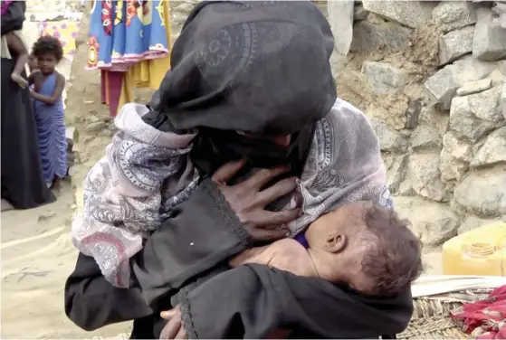  ?? FOTO: TT-AP/HAMMADI ISSA ?? Det svårt undernärda spädbarnet Zahara ammas av sin mamma i staden Aslam i Jemen i augusti 2018.