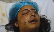  ??  ?? Insha Mushtaq at hospital after being hit by pellets