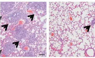  ?? CREDIT: ?? Compared to a control (left), epalrestat treatment (right) reduces the number of metastatic tumors (arrowheads) in the lungs of mice injected with human basal-like breast cancer cells. Wu et al., 2017