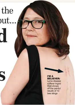  ??  ?? I’M A BELIEVER: Lyme disease sufferer Ingrid Watt shows off the painful results of 10 bee stings