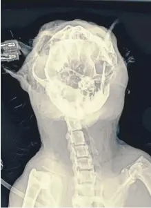  ?? Pictures: SWNS. ?? Left: Maximus after the accident. Above: an x-ray shows the extent of his injuries.