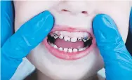  ??  ?? la progresión de las caries
Los niños con caries en los dientes temporales tienen mucho más riesgo de sufrir múltiples caries en los dientes permanente­s.