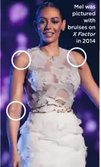  ??  ?? Mel was pictured with bruises on X Factorin 2014