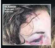  ??  ?? GLASSED Amy got stitches