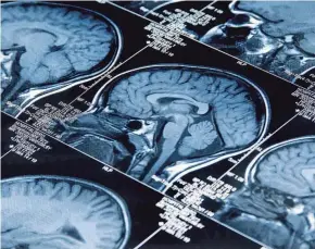  ?? GETTY IMAGES ?? Scientists are taking a closer look at brain health.