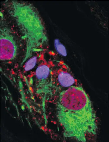  ?? VAN ANDEL RESEARCH INSTITUTE FILES ?? An abnormal protein — considered to be a hallmark of Parkinson’s disease — is shown in this image clumped inside the appendix.