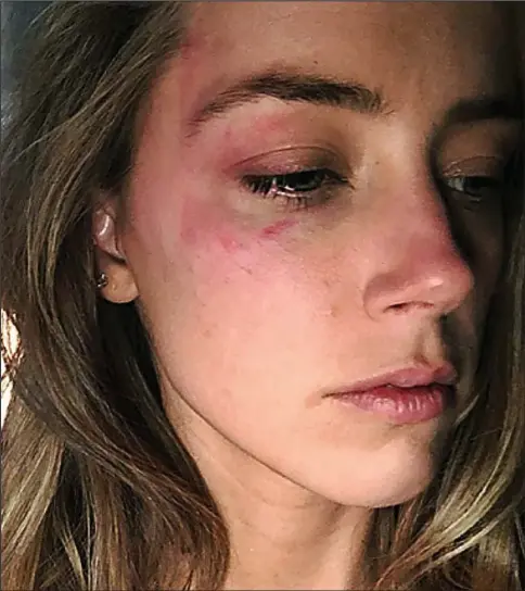  ??  ?? Bruised and battered: This picture of Amber Heard’s injuries – allegedly caused by Depp – was submitted to the court