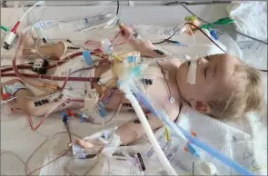  ?? Special to ONG ?? Six-month-old James Lazeski rests sedated, intubated and with his LVAD (left ventricula­r assist device) at Mazankowsk­i Alberta Heart Institute in Edmonton in earlier this month.