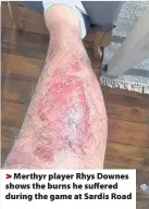  ??  ?? > Merthyr player Rhys Downes shows the burns he suffered during the game at Sardis Road