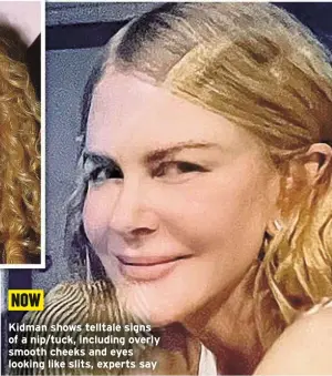  ?? ?? NOW
Kidman shows telltale signs of a nip/tuck, including overly smooth cheeks and eyes looking like slits, experts say