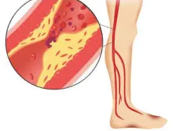  ?? (Pluristem) ?? AN ILLUSTRATI­ON depicts critical limb ischemia, a blockage in the artery causing poor blood flow, which Pluristem hopes to treat.