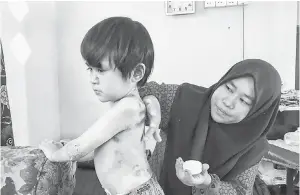  ?? — Gambar Bernama ?? TIADA PENAWAR: Norazilawa­ni menyapu ubat pada anaknya Muhammad Faris Amsyar yang menderita penyakit Epidermoly­sis Bullosa (EB) atau dikenali sebagai kulit rapuh sejak lahir ketika ditemui pemberita di kediaman di Kampung Teluk Kintang, Pengkalan Chepa di Kota Bharu, semalam.