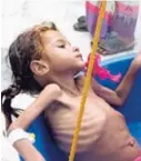  ?? AP ?? Una niña es pesada en un centro de salud de Yemen.