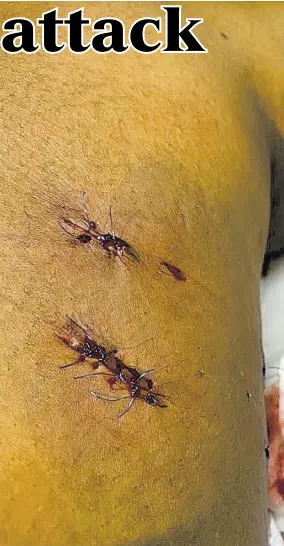  ??  ?? Dog bite wounds are seen on the leg of a Portmore woman who was attacked on November 17 during her morning exercise.