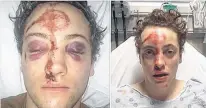  ?? FACEBOOK ?? Chance Johnson suffered multiple face and head injuries after reportedly being deliberate­ly struck by a vehicle and robbed.