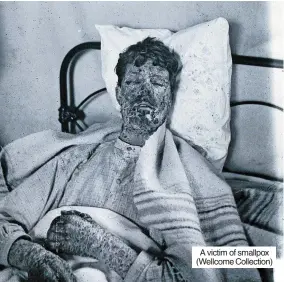  ?? ?? A victim of smallpox (Wellcome Collection)