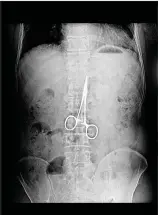  ?? ?? An internet picture depicting a foreign object left inside a patient’s body after a surgery. This is not to suggest that this is the object referred to in the story.