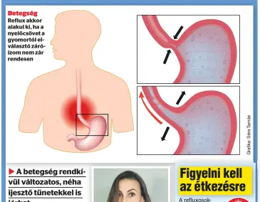  ?? ?? Betegség
Reflux akkor alakul ki, ha a nyelőcsöve­t a gyomortól elválasztó záróizom nem zár rendesen