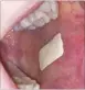  ??  ?? UNIVERSITY OF SHEFFIELD The biodegrada­ble patch sticks inside the mouth and helps to accelerate the treatment of painful ulcers.