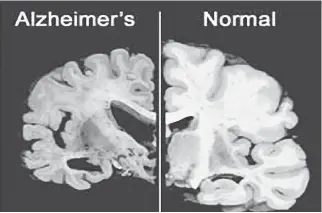  ?? THE ASSOCIATED PRESS/FILES ?? These photograph­s from Merck & Co. show brains in cross-section. On the left is a brain afflicted with Alzheimer’s disease while the image on the right is of a normal brain.