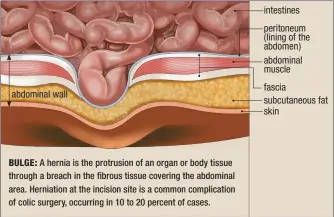  ??  ?? abdominal wallBULGE: A hernia is the protrusion of an organ or body tissue through a breach in the fibrous tissue covering the abdominal area. Herniation at the incision site is a common complicati­on of colic surgery, occurring in 10 to 20 percent of cases. intestines peritoneum ( lining of the abdomen) abdominal muscle fascia subcutaneo­us fat skin