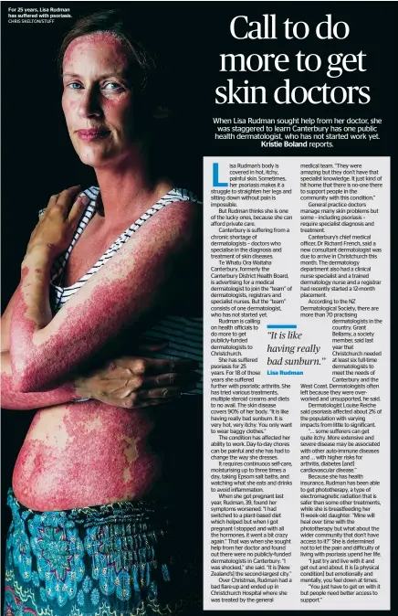  ?? CHRIS SKELTON/STUFF ?? For 25 years, Lisa Rudman has suffered with psoriasis.