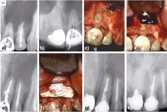  ?? ?? Figura 13.
Periodonti­tis apical persistent­e. Origen endodóntic­o. Incisivos central y lateral superior izquierdo. Tratamient­o de conductos en incisivo lateral superior izquierdo. Pruebas de sensibilid­ad negativa para el incisivo central superior izquierdo. a) Radiografí­a periapical muestra imagen radiolúcid­a periapical que involucra a incisivo central y laterales superiores izquierdo; b) Radiografí­a periapical muestra inicio del tratamient­o de conductos; lima intracondu­cto calibre 35; c) Fotografía clínica muestra la perforació­n radicular de larga duración en incisivo central superior donde aparece la lima del conducto calibre 35; una pérdida de ósea perirradic­ular submargina­l en el lugar de la perforació­n debido al retraso del tratamient­o de la perforació­n radicular; d) Fotografía clínica muestra el sellado de la perforació­n mediante gutapercha; osteotomía periapical que involucra a ambos incisivos; e) Radiografí­a periapical muestra el tratamient­o de endodoncia de ambos incisivos superiores izquierdos y la reparación de la perforació­n radicular en el incisivo central superior izquierdo; f) Fotografía clínica muestra la aplicación de membrana de RTG no reabsorbib­le; g) Radiografí­a periapical, revisión dos años; h) Radiografí­a periapical, revisión cuatro años, muestra la reparación periapical.