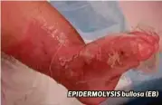  ??  ?? EPIDERMOLY­SIS bullosa (EB)