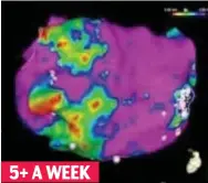  ??  ?? Damage: Heart scans show how increased alcohol consumptio­n can disrupt electrical signals that lead to irregular rhythms 5+ A WEEK