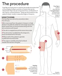  ?? Graphic: Nolo Moima ?? 2 3 5 Skin Nerve Healing: 6-8 weeks to heal, depending on the general health of the patient. 1 4 Free flap is used to describe the "transplant­ation" of tissue from one site of the body to another. 1