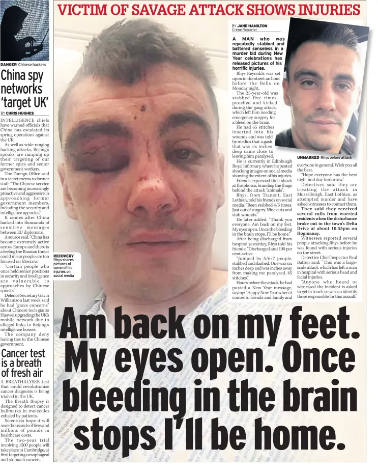  ??  ?? DANGER Chinese hackers RECOVERY Rhys shares pictures of some of his injuries on social media UNMARKED Rhys before attack