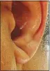  ??  ?? DANGER SIGN: The distinctiv­e ear crease that could warn of a stroke