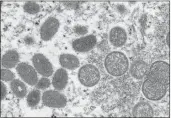  ?? CYNTHIA S. GOLDSMITH, RUSSELL REGNER — CDC VIA AP, FILE ?? Mature, oval-shaped monkeypox virions, left, and spherical immature virions, right, obtained from a sample of human skin associated with the 2003prairi­e dog outbreak.