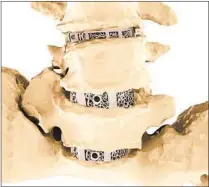  ?? COURTESY PHOTO ?? Carlsmed creates customized implants, made of titanium, for surgeries to straighten out the spine, improving upon convention­al implants that may not fit exactly, requiring additional surgeries to get it right.