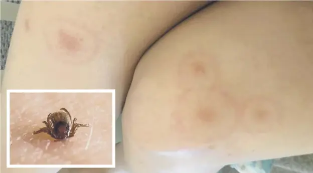  ??  ?? 0 Many people with early symptoms of Lyme disease develop a circular red skin rash around a tick bite, often described as looking like a bullseye on a dart board