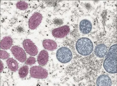  ?? Smith Collection/Gado / Gado via Getty Images ?? A digitally colorized electron microscopi­c image depicting a monkeypox virus particle, obtained from a clinical sample associated with a 2003 prairie dog outbreak.