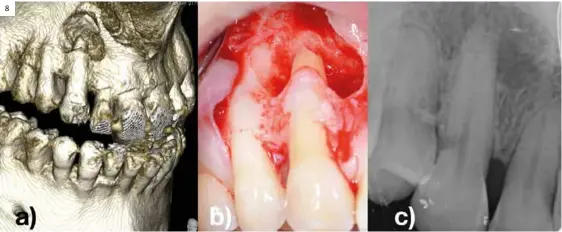  ??  ?? 8 Figura 8. a) Corte 3D de imagen periapical en 13 con reabsorció­n radicular apical de un diente que previament­e estaba incluido y ha sido ubicado en su posición mediante tracción ortodóntic­a. b) Imagen intraquirú­rgica de 13 donde se puede apreciar el alcance de la lesión. c) Radiografí­a periapical de la reabsorció­n externa que alcanza la pulpa provocada por la tracción ortodóntic­a.