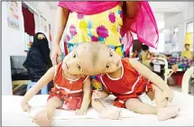  ??  ?? Bangladesh­i conjoined twin baby girls Rabia and Rukia sit in a hospital in Dhaka on July 15. The one-year-old twins were visiting the hospital for a check-up and will have to wait for a medical opinion on whether they will be
able to undergo surgery...