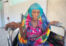  ?? FOTO: REUTERS/NTB SCANPIX ?? ALVORLIG UNDERERNAE­RT: 18 år gamle Saida Ahmad Baghili er en av stadig flere ofre i borgerkrig­en i Jemen. Hun får nå behandling på al-Thawra-sykehuset i Houdieda.
